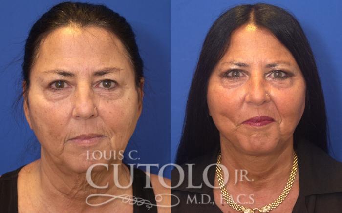 Before & After Rejuvelift™ Case 126 View #1 View in Brooklyn, Staten Island, Queens, NY