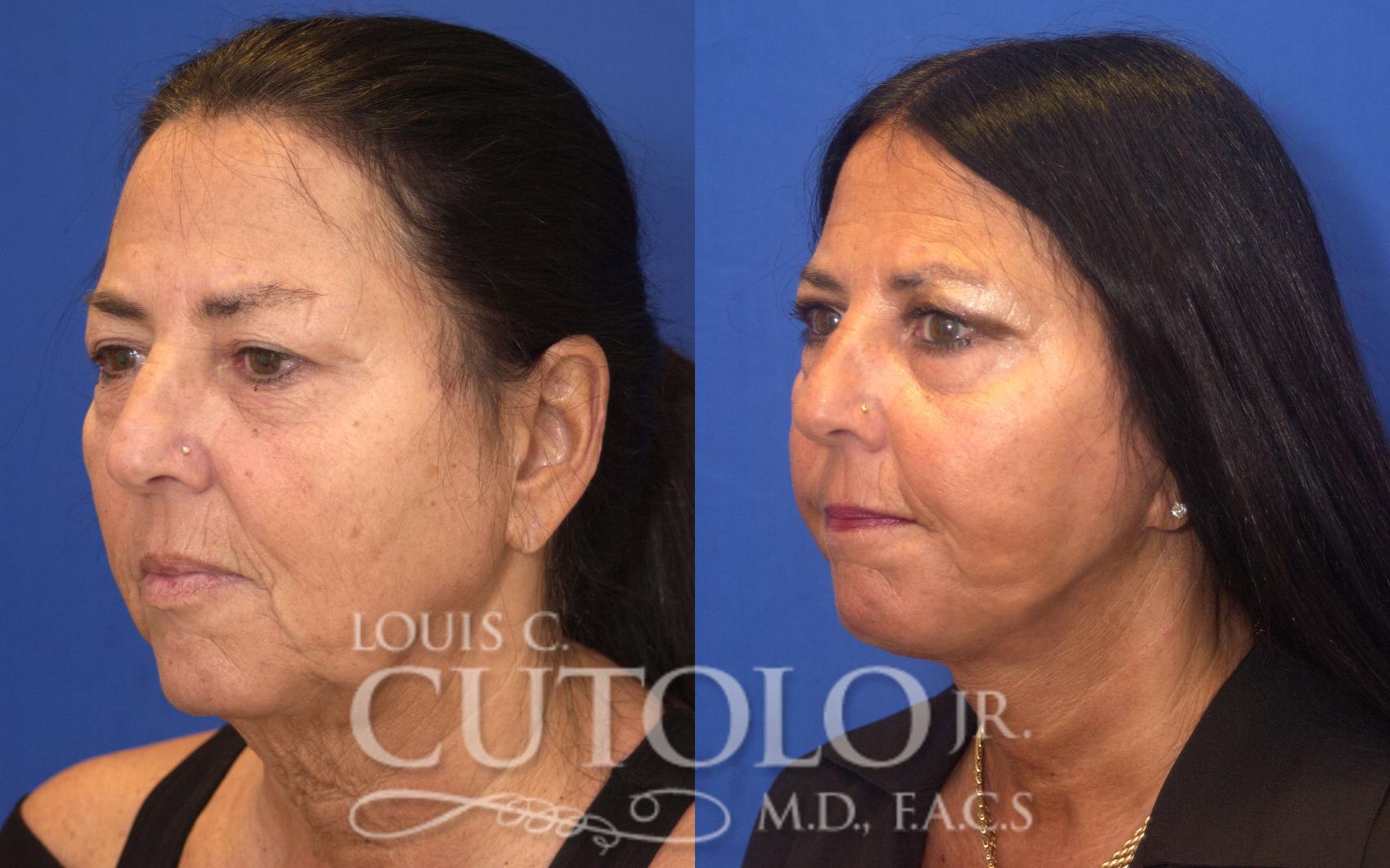 Before & After Rejuvelift™ - Mini Lift Case 126 View #2 View in Brooklyn, Staten Island, Queens, NY