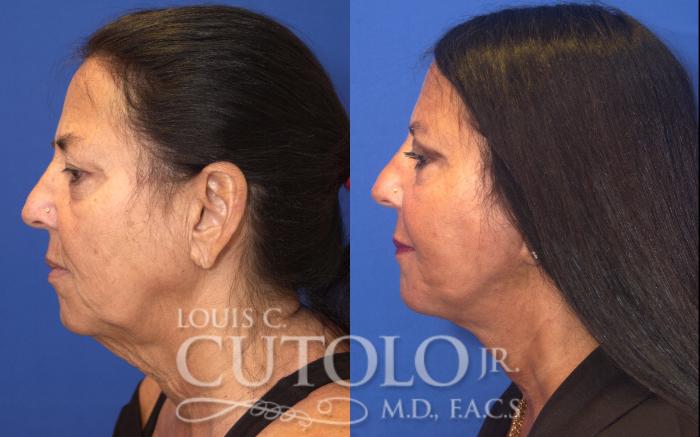 Before & After Rejuvelift™ Case 126 View #3 View in Brooklyn, Staten Island, Queens, NY