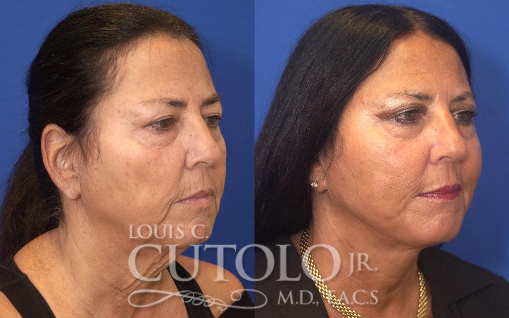 Before & After Rejuvelift™ - Mini Lift Case 126 View #4 View in Brooklyn, Staten Island, Queens, NY