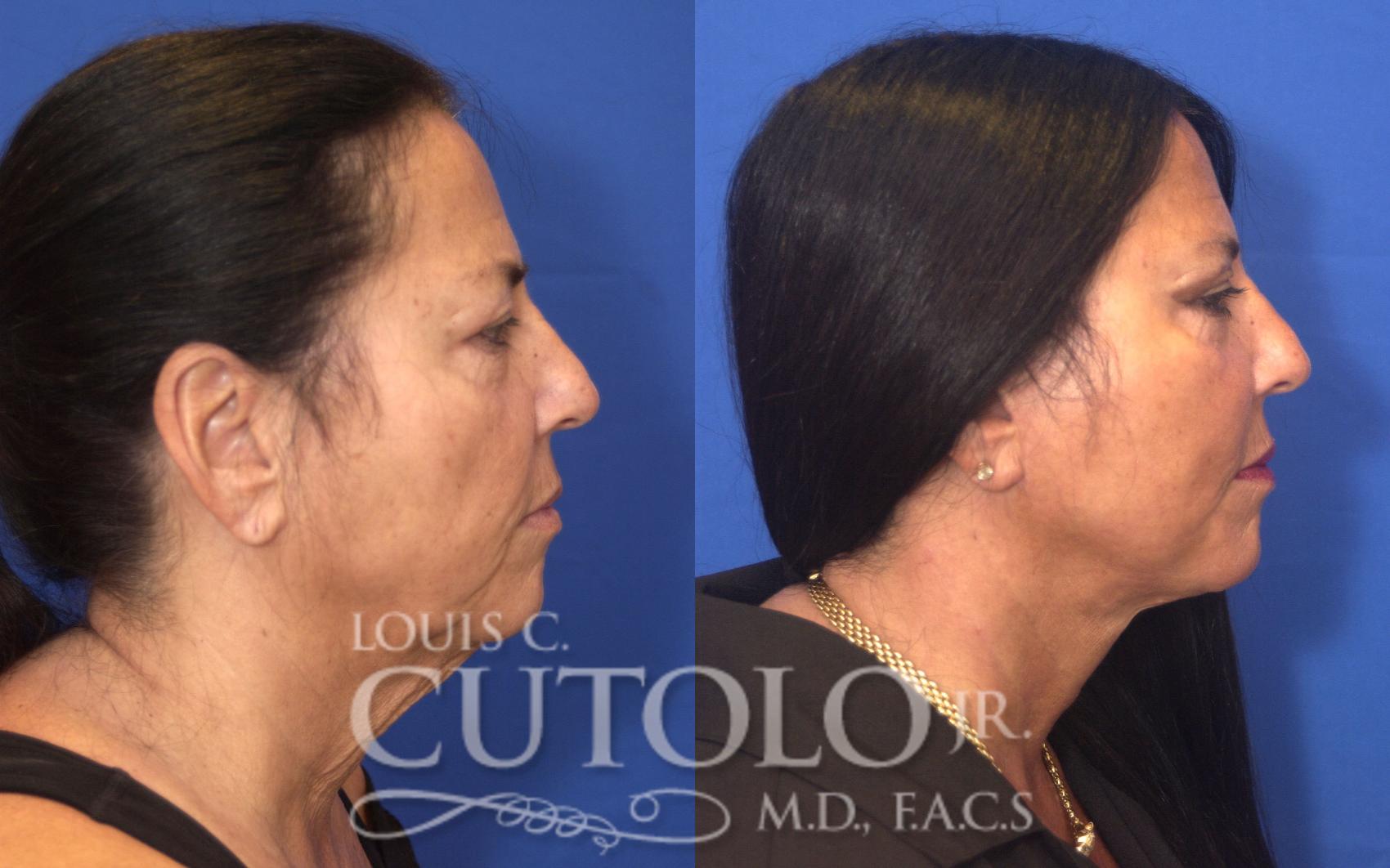Before & After Rejuvelift™ - Mini Lift Case 126 View #5 View in Brooklyn, Staten Island, Queens, NY