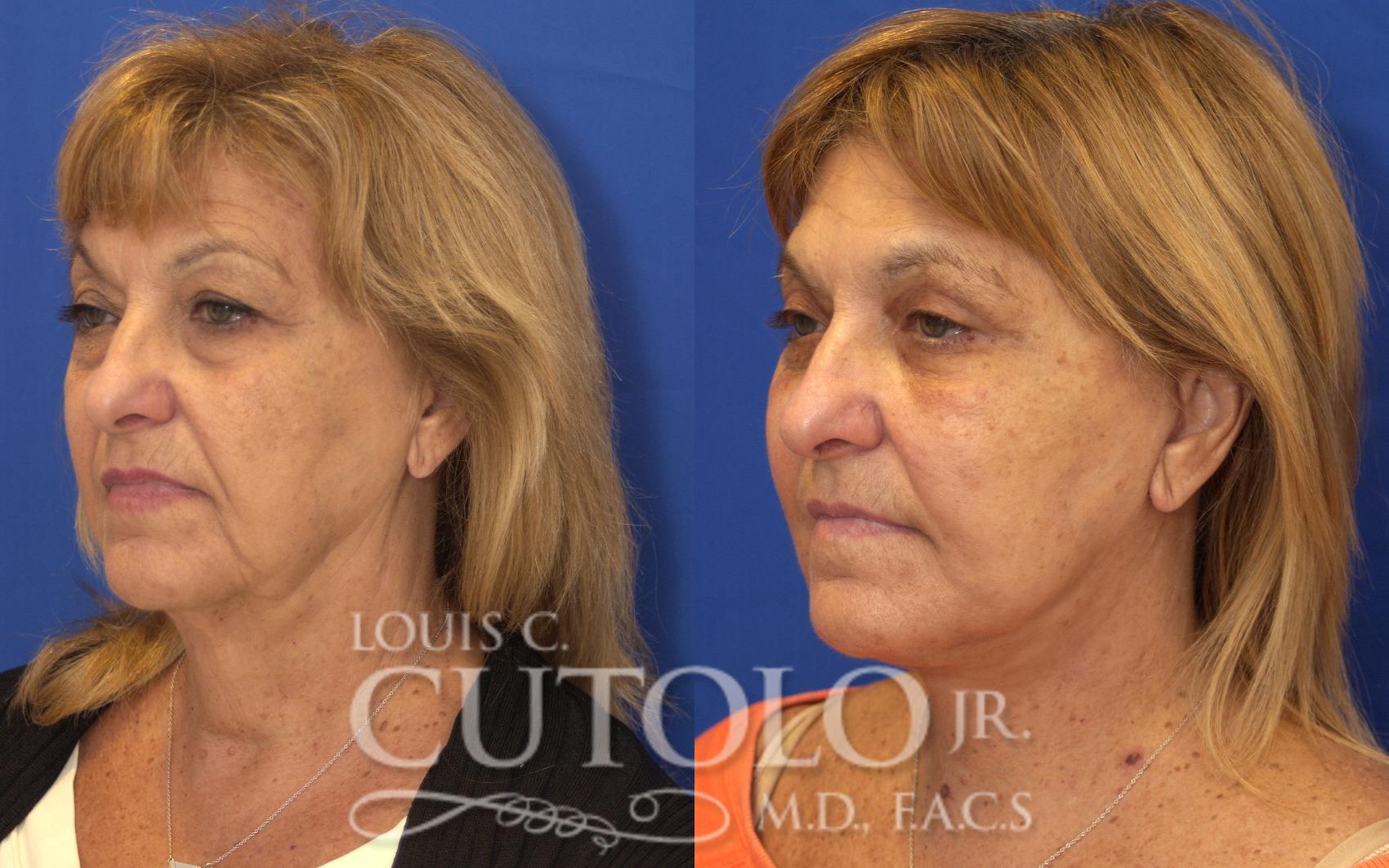 Before & After Rejuvelift™ - Mini Lift Case 127 View #2 View in Brooklyn, Staten Island, Queens, NY