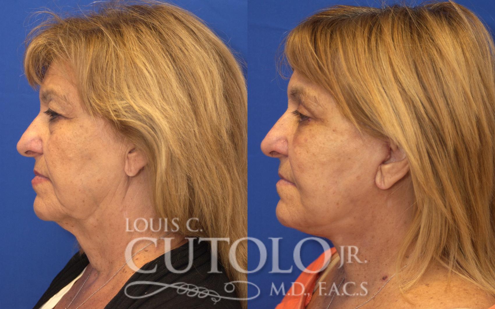 Before & After Rejuvelift™ - Mini Lift Case 127 View #3 View in Brooklyn, Staten Island, Queens, NY