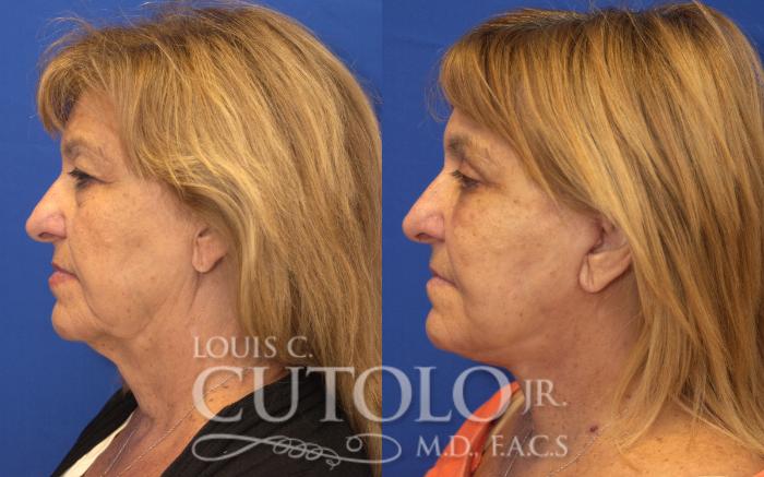 Before & After Rejuvelift™ Case 127 View #3 View in Brooklyn, Staten Island, Queens, NY