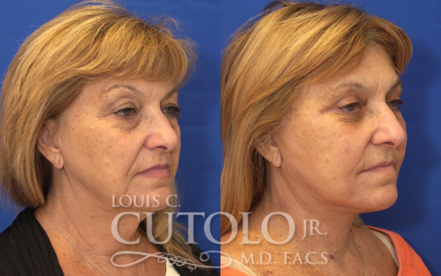 Before & After Rejuvelift™ - Mini Lift Case 127 View #4 View in Brooklyn, Staten Island, Queens, NY