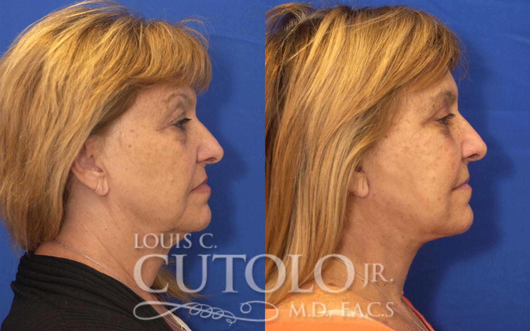 Before & After Rejuvelift™ - Mini Lift Case 127 View #5 View in Brooklyn, Staten Island, Queens, NY