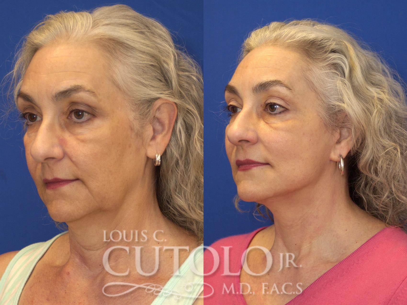 Before & After Rejuvelift™ - Mini Lift Case 133 View #2 View in Brooklyn, Staten Island, Queens, NY