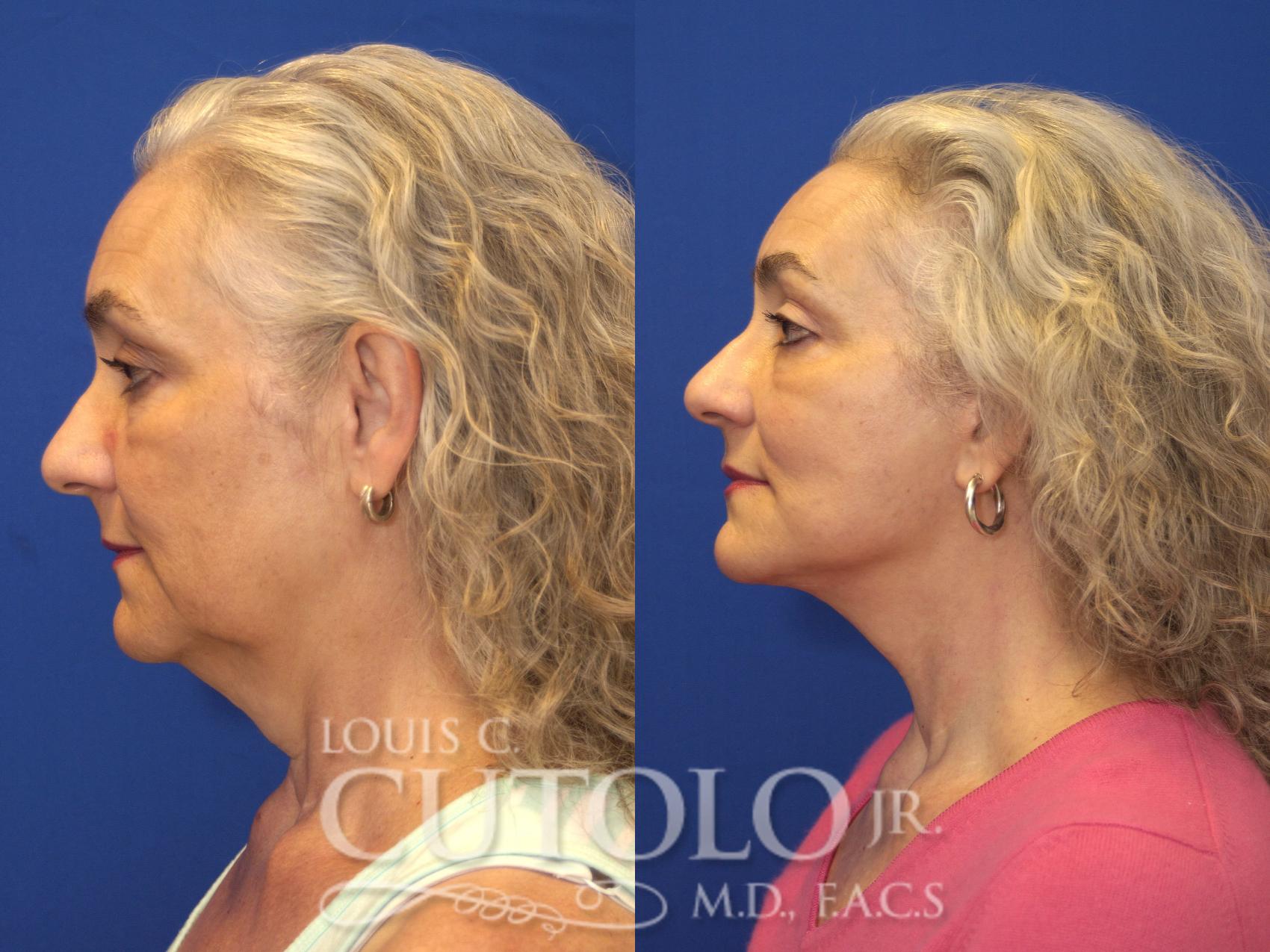 Before & After Rejuvelift™ - Mini Lift Case 133 View #3 View in Brooklyn, Staten Island, Queens, NY