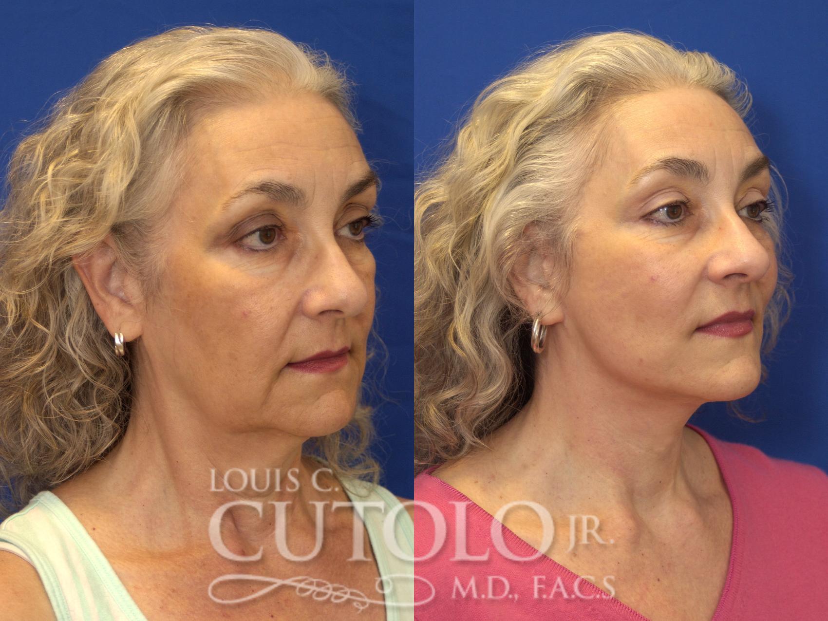 Before & After Rejuvelift™ - Mini Lift Case 133 View #4 View in Brooklyn, Staten Island, Queens, NY