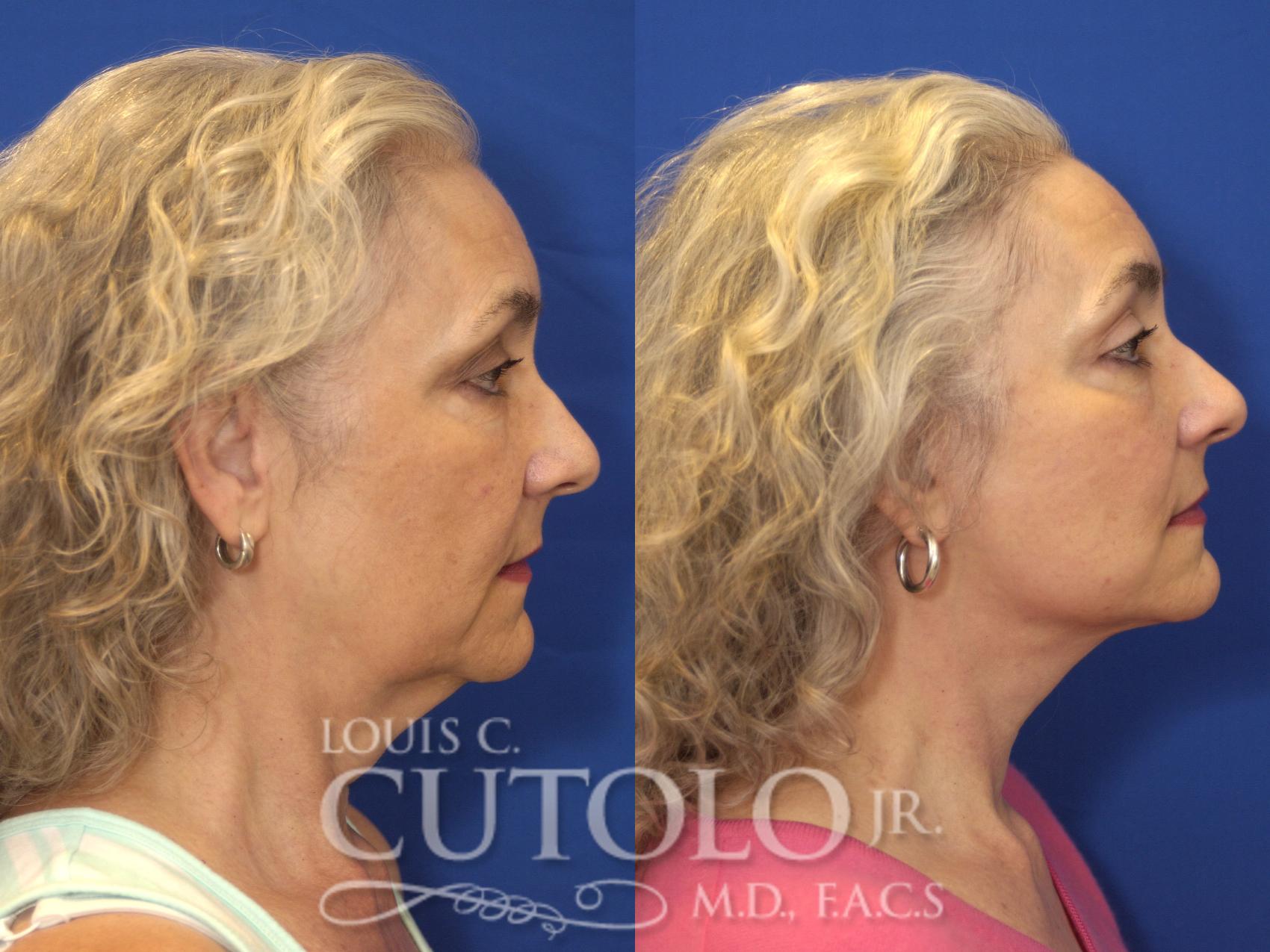 Before & After Rejuvelift™ - Mini Lift Case 133 View #5 View in Brooklyn, Staten Island, Queens, NY