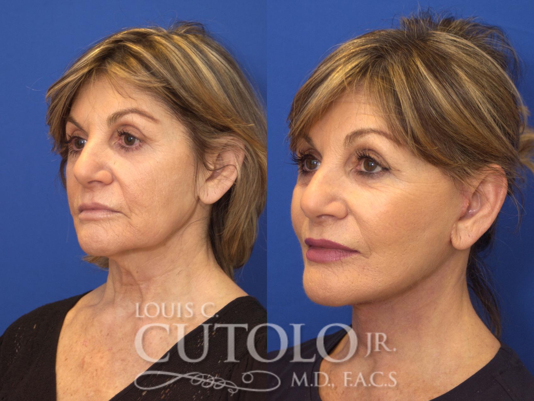 Before & After Rejuvelift™ - Mini Lift Case 134 View #2 View in Brooklyn, Staten Island, Queens, NY