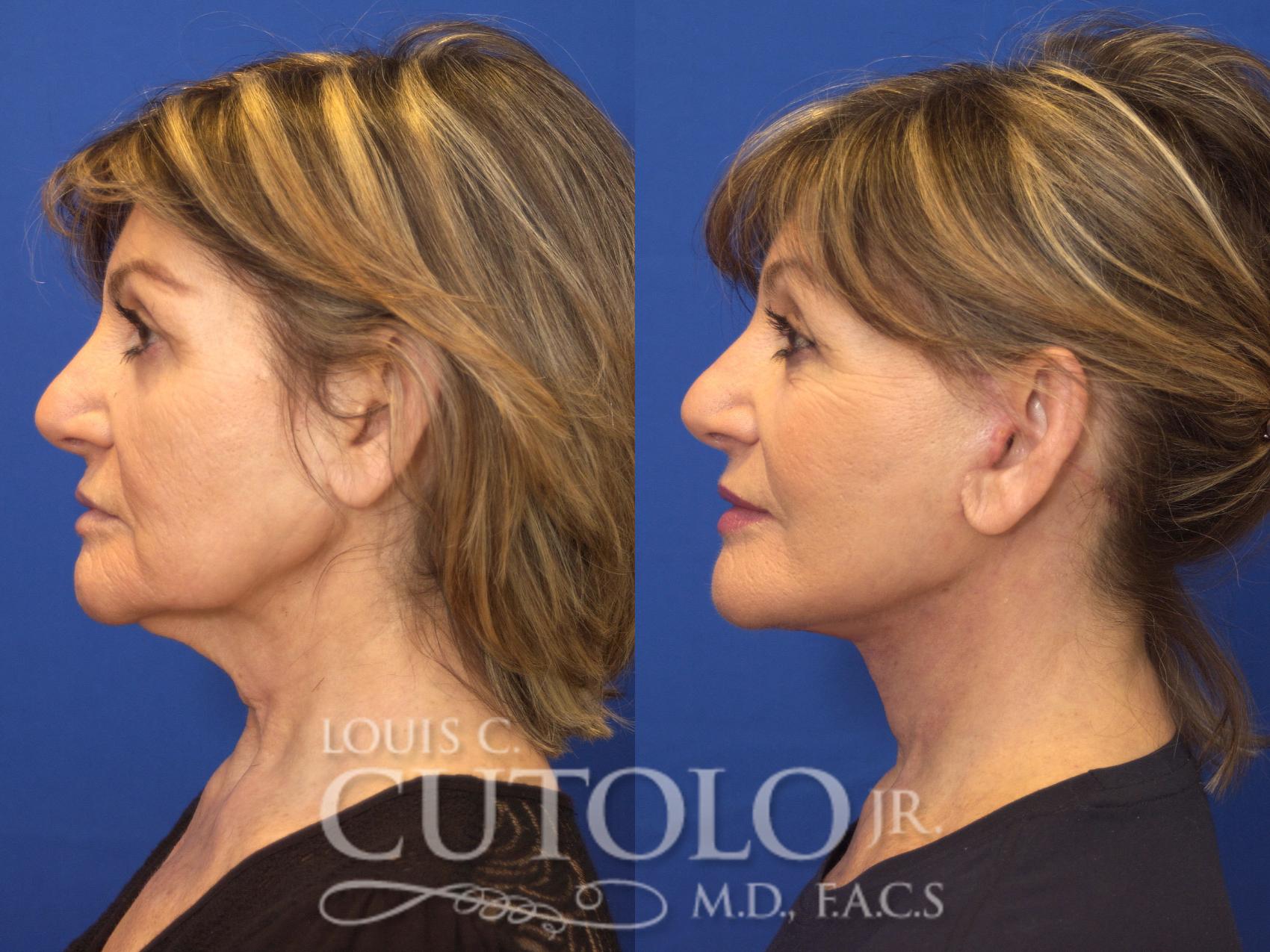 Before & After Rejuvelift™ - Mini Lift Case 134 View #3 View in Brooklyn, Staten Island, Queens, NY