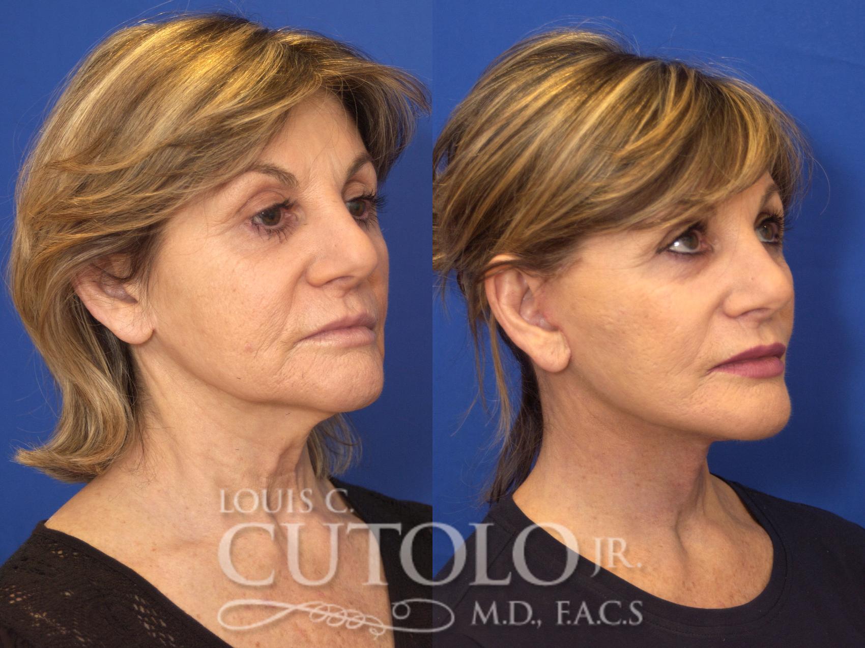Before & After Rejuvelift™ - Mini Lift Case 134 View #4 View in Brooklyn, Staten Island, Queens, NY