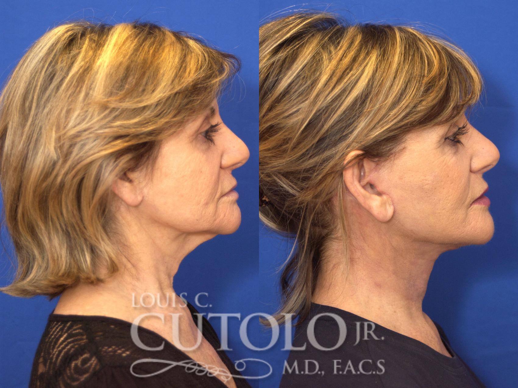 Before & After Rejuvelift™ - Mini Lift Case 134 View #5 View in Brooklyn, Staten Island, Queens, NY