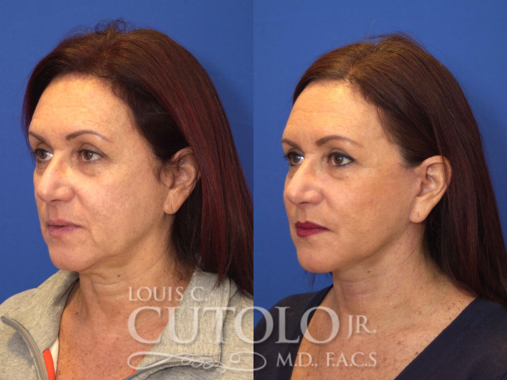 Before & After Rejuvelift™ - Mini Lift Case 135 View #2 View in Brooklyn, Staten Island, Queens, NY