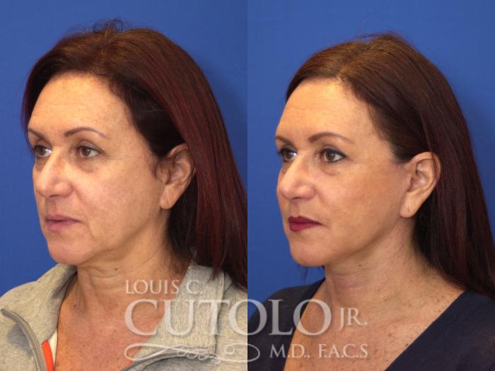 Before & After Rejuvelift™ Case 135 View #2 View in Brooklyn, Staten Island, Queens, NY