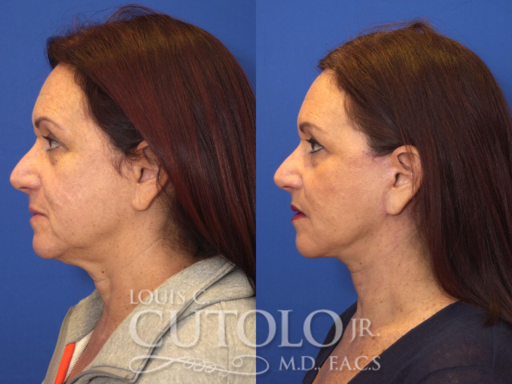 Before & After Rejuvelift™ - Mini Lift Case 135 View #3 View in Brooklyn, Staten Island, Queens, NY