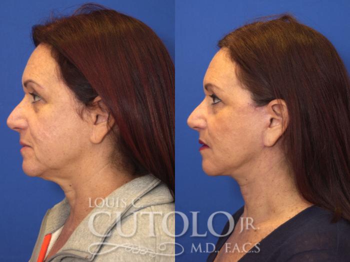 Before & After Rejuvelift™ Case 135 View #3 View in Brooklyn, Staten Island, Queens, NY