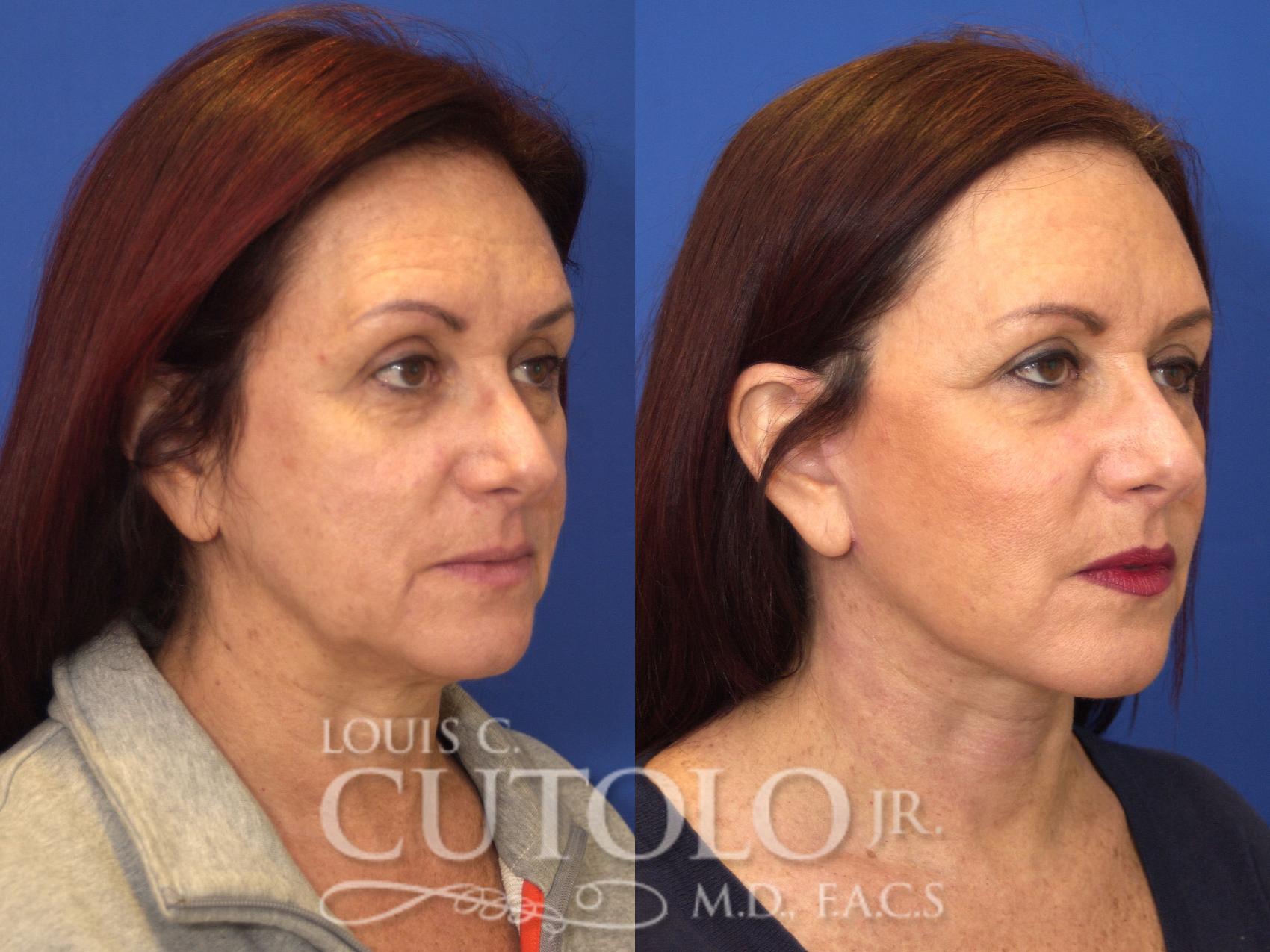 Before & After Rejuvelift™ - Mini Lift Case 135 View #4 View in Brooklyn, Staten Island, Queens, NY
