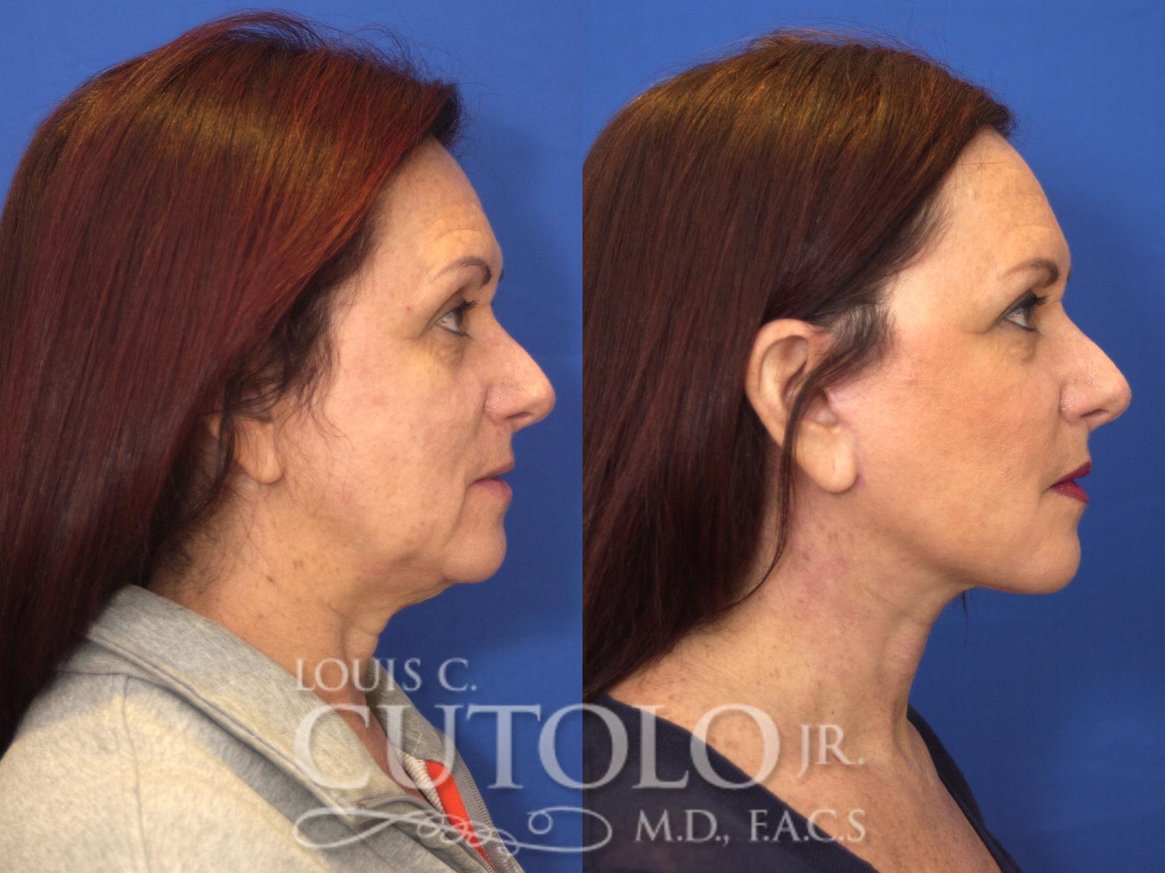 Before & After Rejuvelift™ - Mini Lift Case 135 View #5 View in Brooklyn, Staten Island, Queens, NY