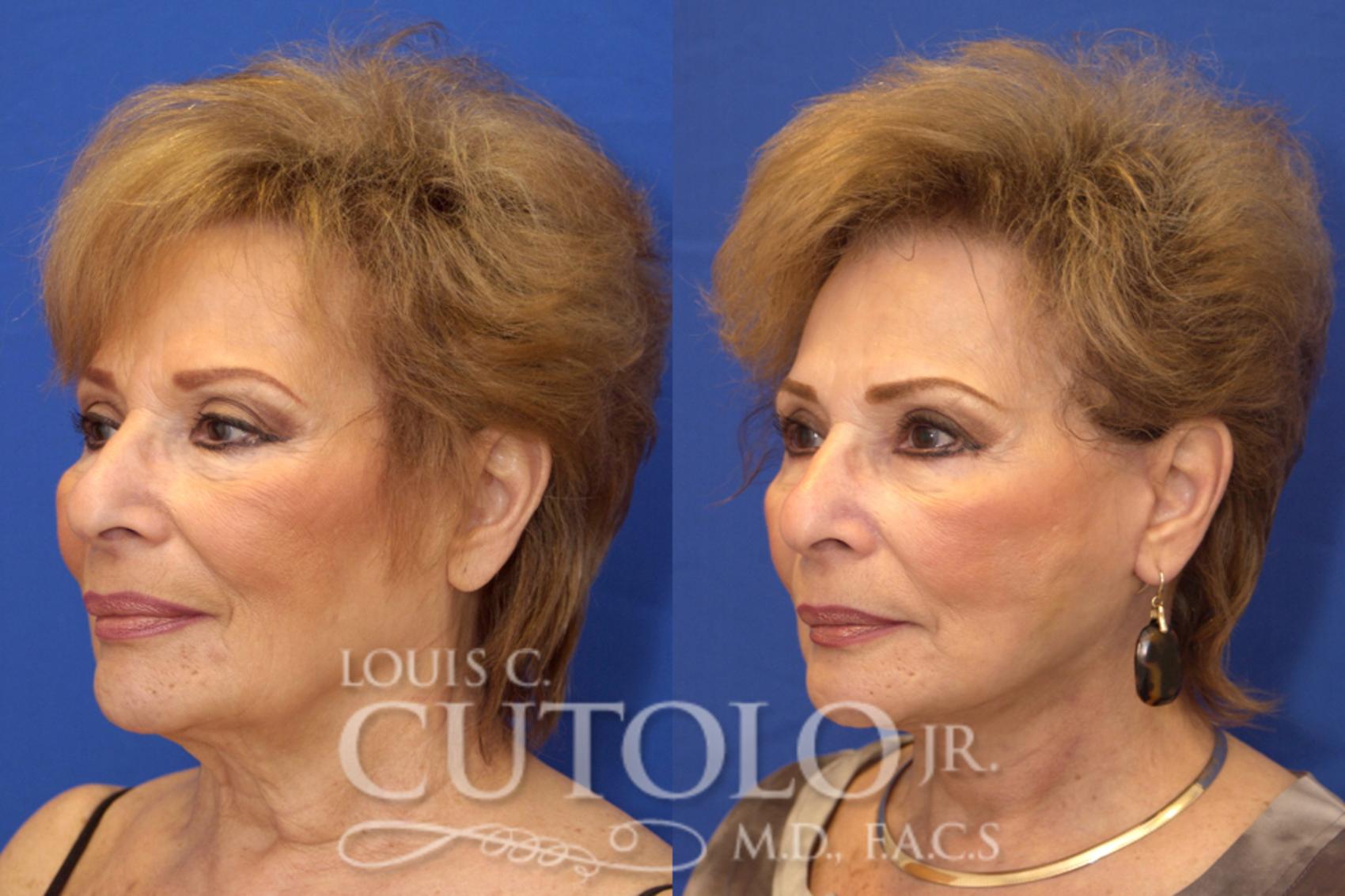 Before & After Rejuvelift™ - Mini Lift Case 14 View #2 View in Brooklyn, Staten Island, Queens, NY
