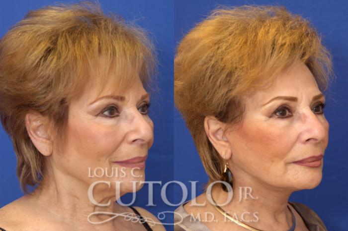 Before & After Rejuvelift™ Case 14 View #3 View in Brooklyn, Staten Island, Queens, NY