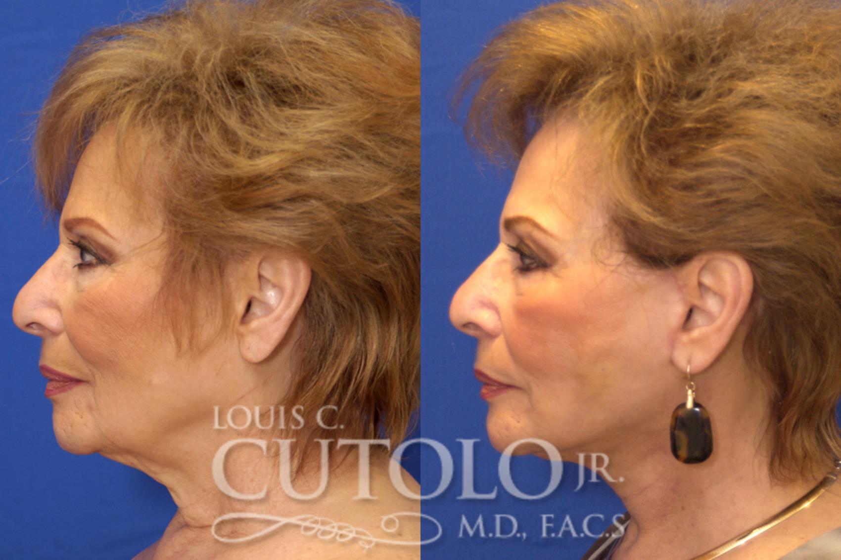 Before & After Rejuvelift™ - Mini Lift Case 14 View #4 View in Brooklyn, Staten Island, Queens, NY