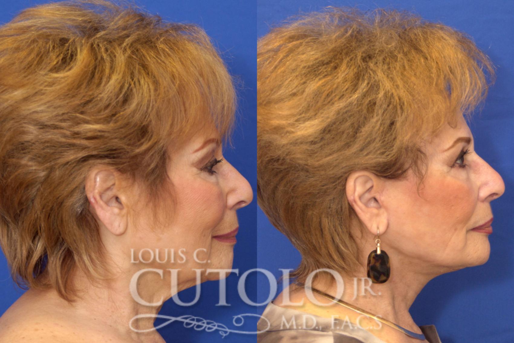 Before & After Rejuvelift™ - Mini Lift Case 14 View #5 View in Brooklyn, Staten Island, Queens, NY