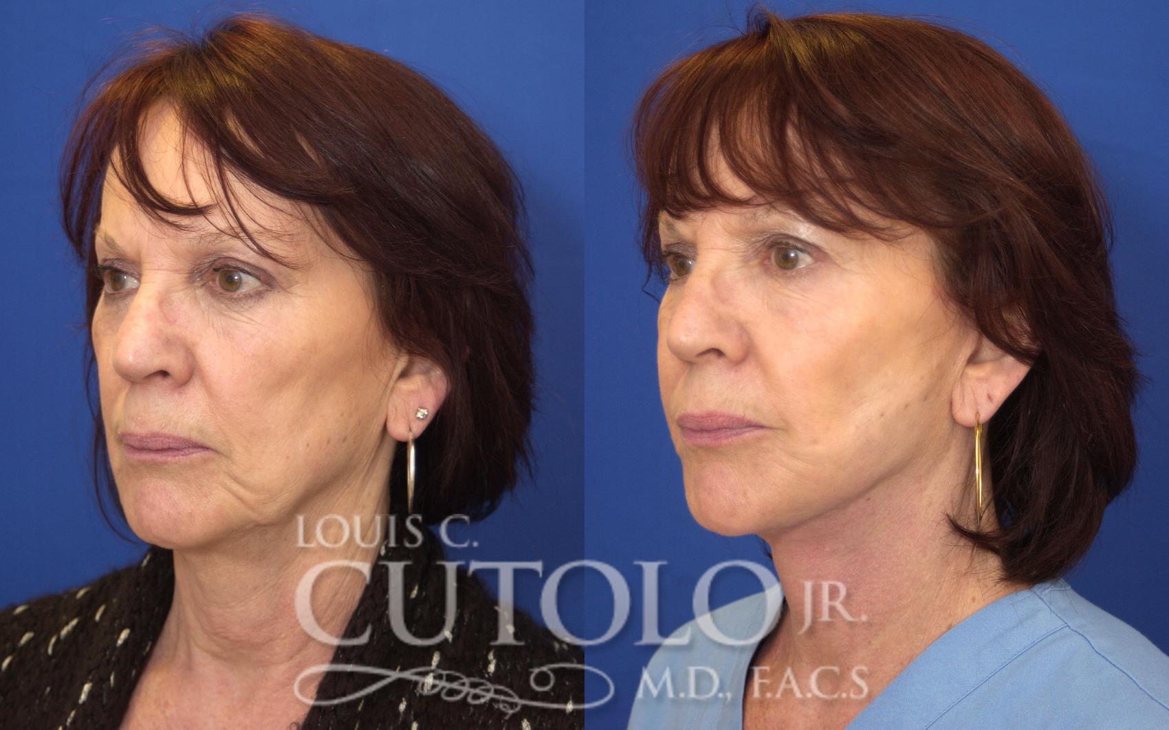 Before & After Rejuvelift™ - Mini Lift Case 142 View #2 View in Brooklyn, Staten Island, Queens, NY