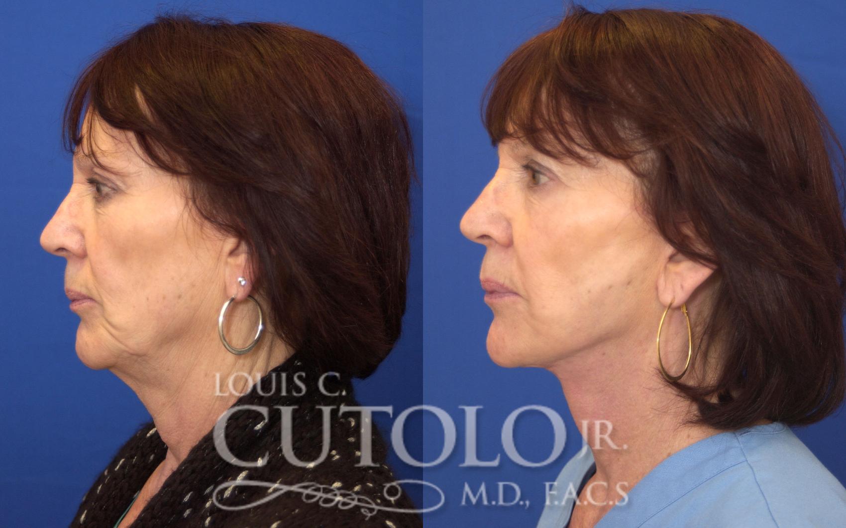Before & After Rejuvelift™ - Mini Lift Case 142 View #3 View in Brooklyn, Staten Island, Queens, NY