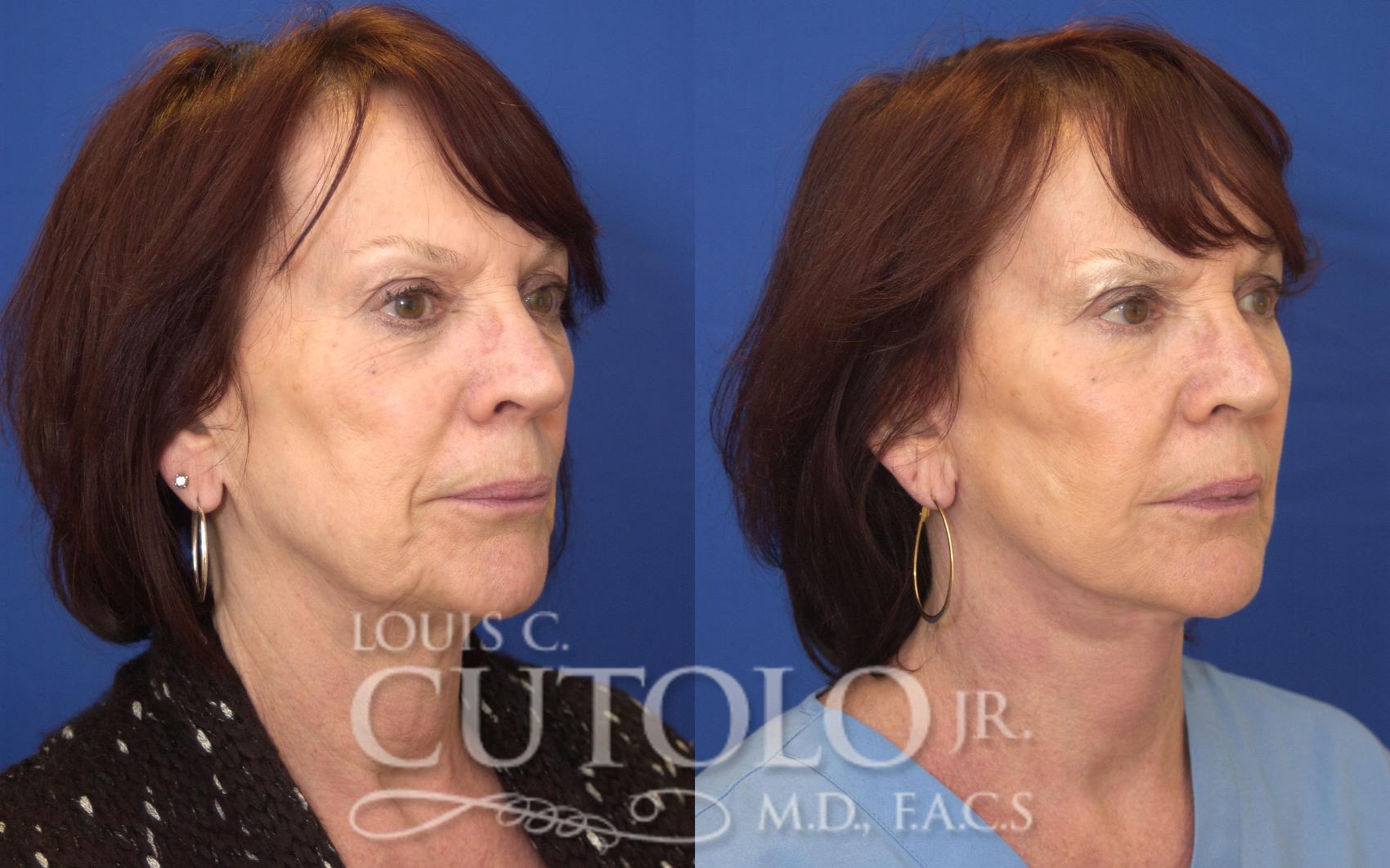 Before & After Rejuvelift™ - Mini Lift Case 142 View #4 View in Brooklyn, Staten Island, Queens, NY