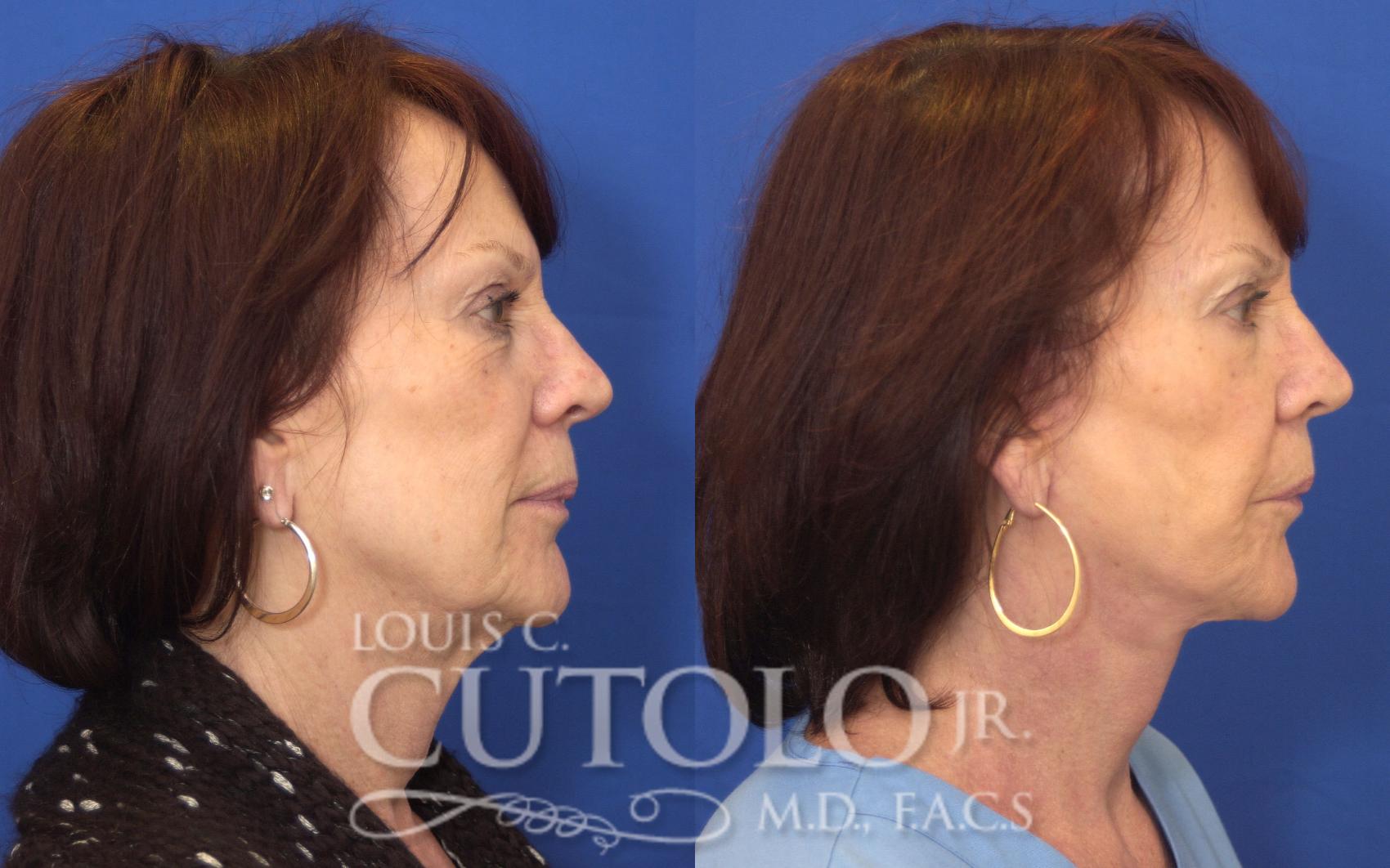 Before & After Rejuvelift™ - Mini Lift Case 142 View #5 View in Brooklyn, Staten Island, Queens, NY