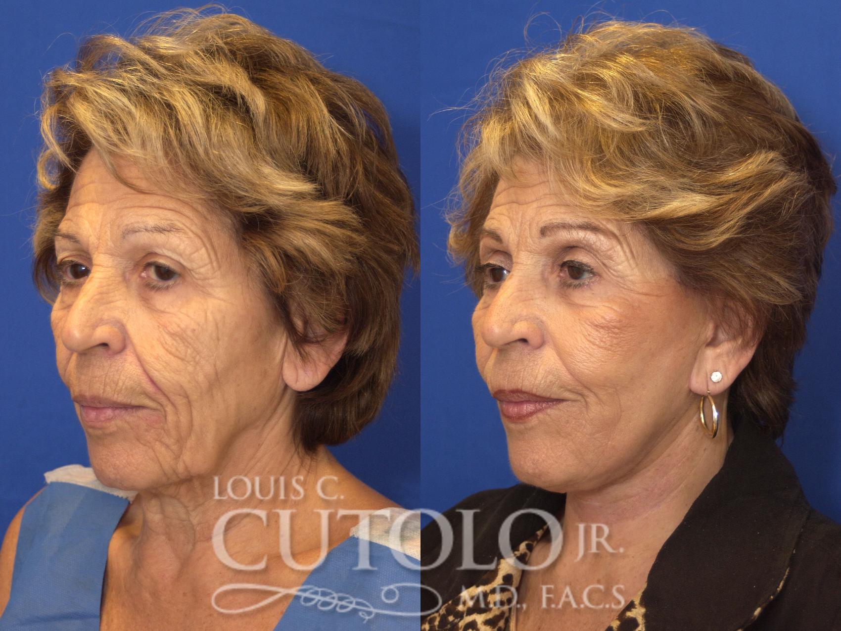 Before & After Rejuvelift™ - Mini Lift Case 144 View #2 View in Brooklyn, Staten Island, Queens, NY