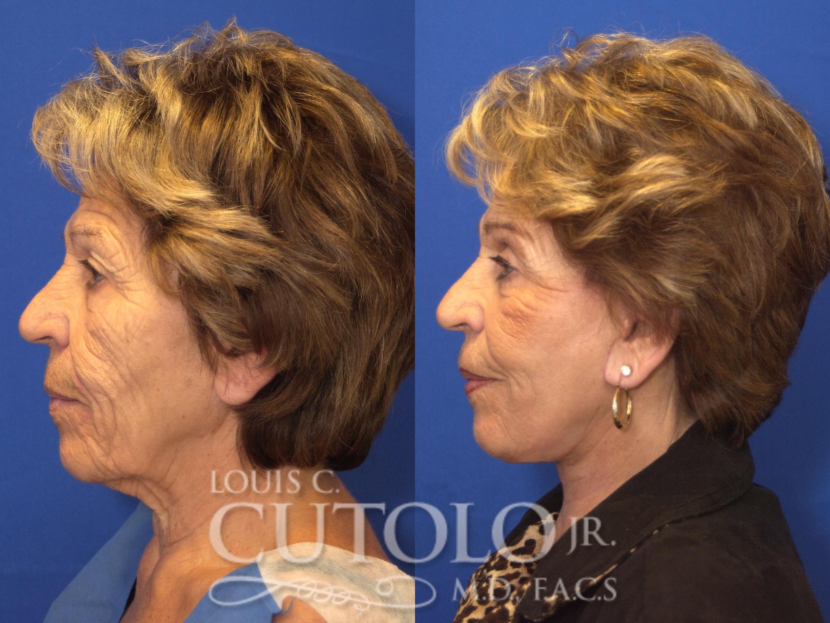 Before & After Rejuvelift™ - Mini Lift Case 144 View #3 View in Brooklyn, Staten Island, Queens, NY