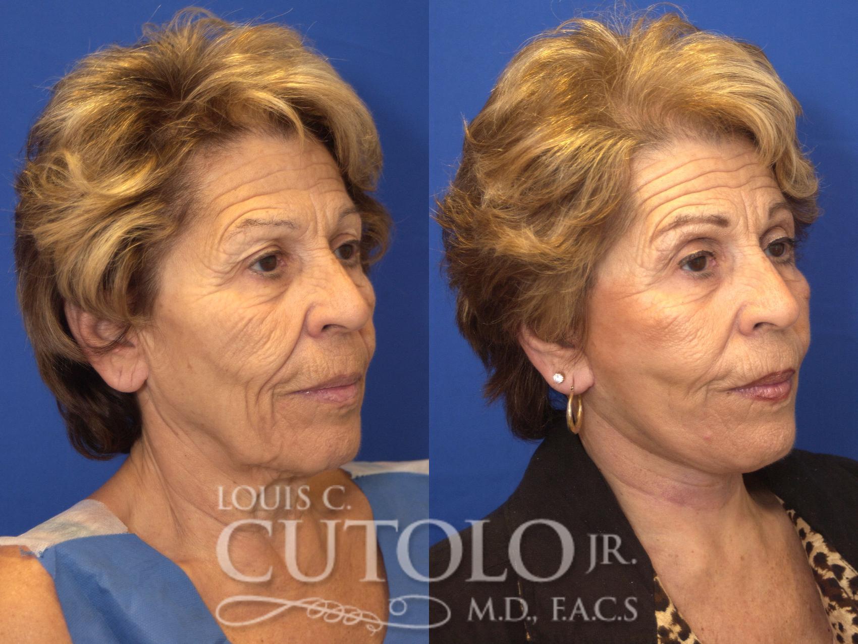 Before & After Rejuvelift™ - Mini Lift Case 144 View #4 View in Brooklyn, Staten Island, Queens, NY