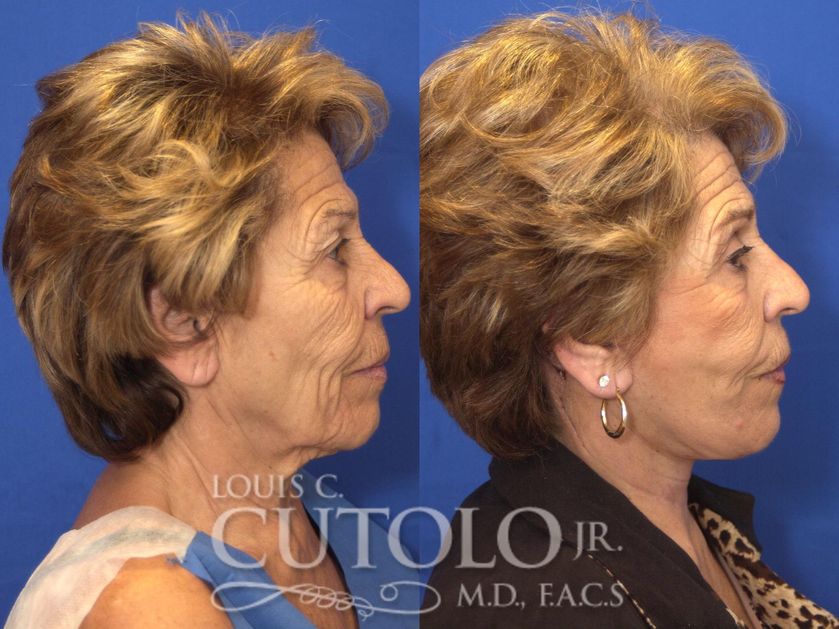 Before & After Rejuvelift™ - Mini Lift Case 144 View #5 View in Brooklyn, Staten Island, Queens, NY