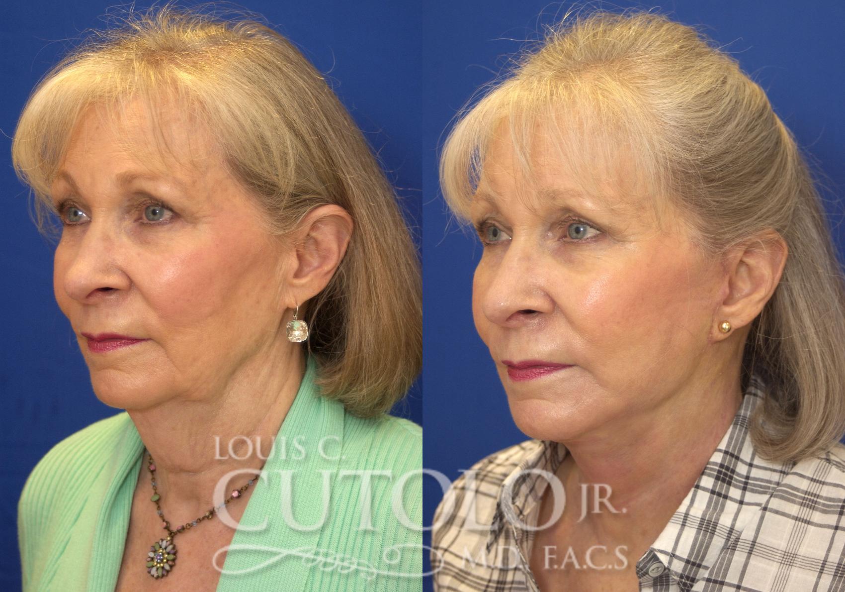 Before & After Rejuvelift™ - Mini Lift Case 149 View #2 View in Brooklyn, Staten Island, Queens, NY