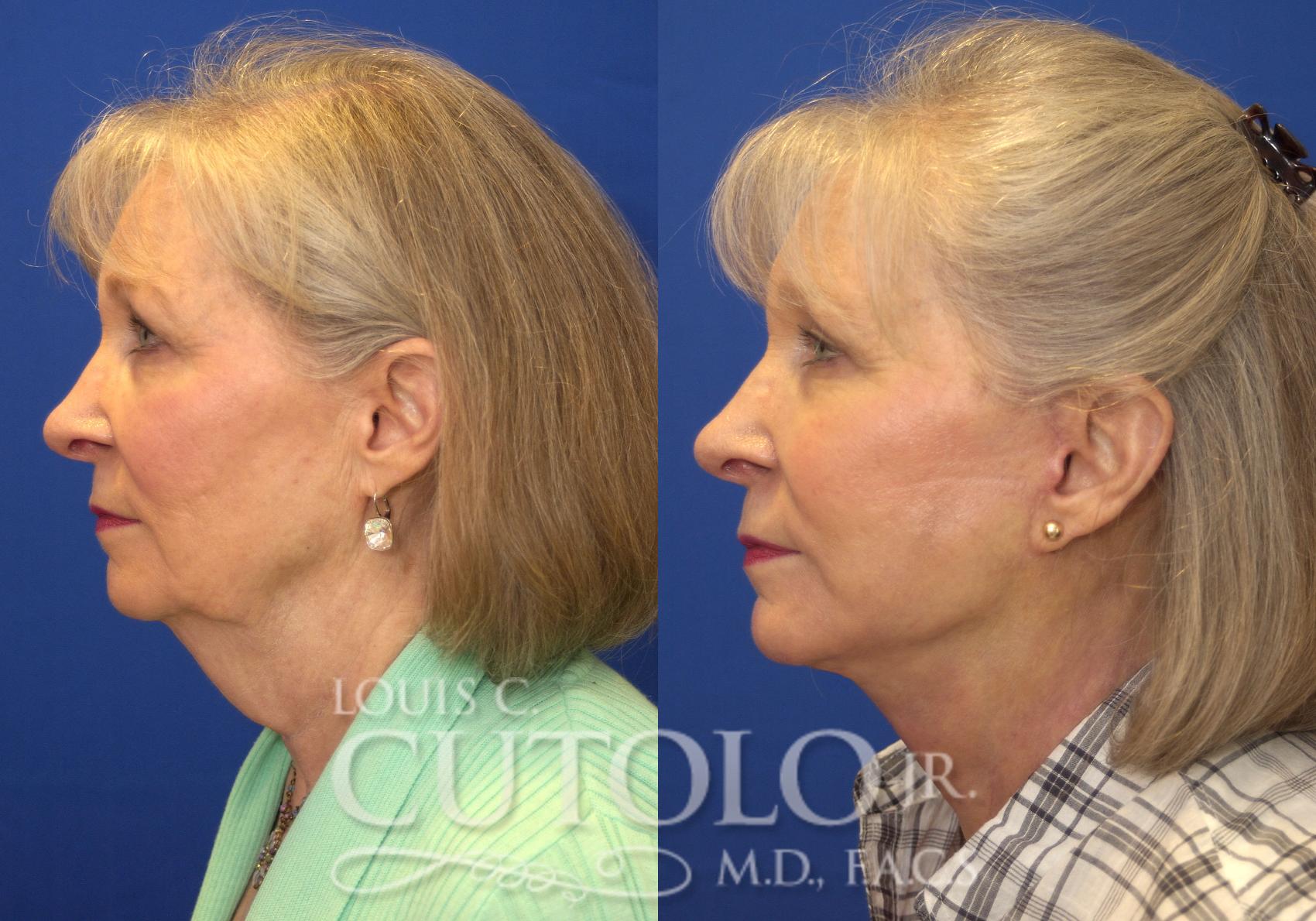 Before & After Rejuvelift™ - Mini Lift Case 149 View #3 View in Brooklyn, Staten Island, Queens, NY
