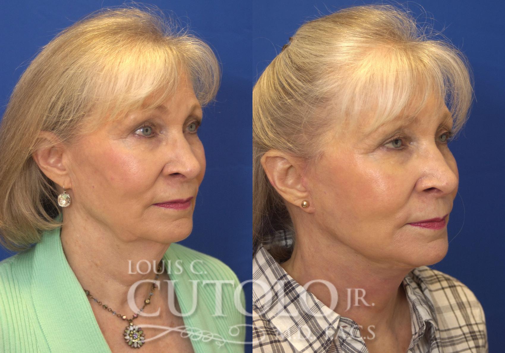 Before & After Rejuvelift™ - Mini Lift Case 149 View #4 View in Brooklyn, Staten Island, Queens, NY