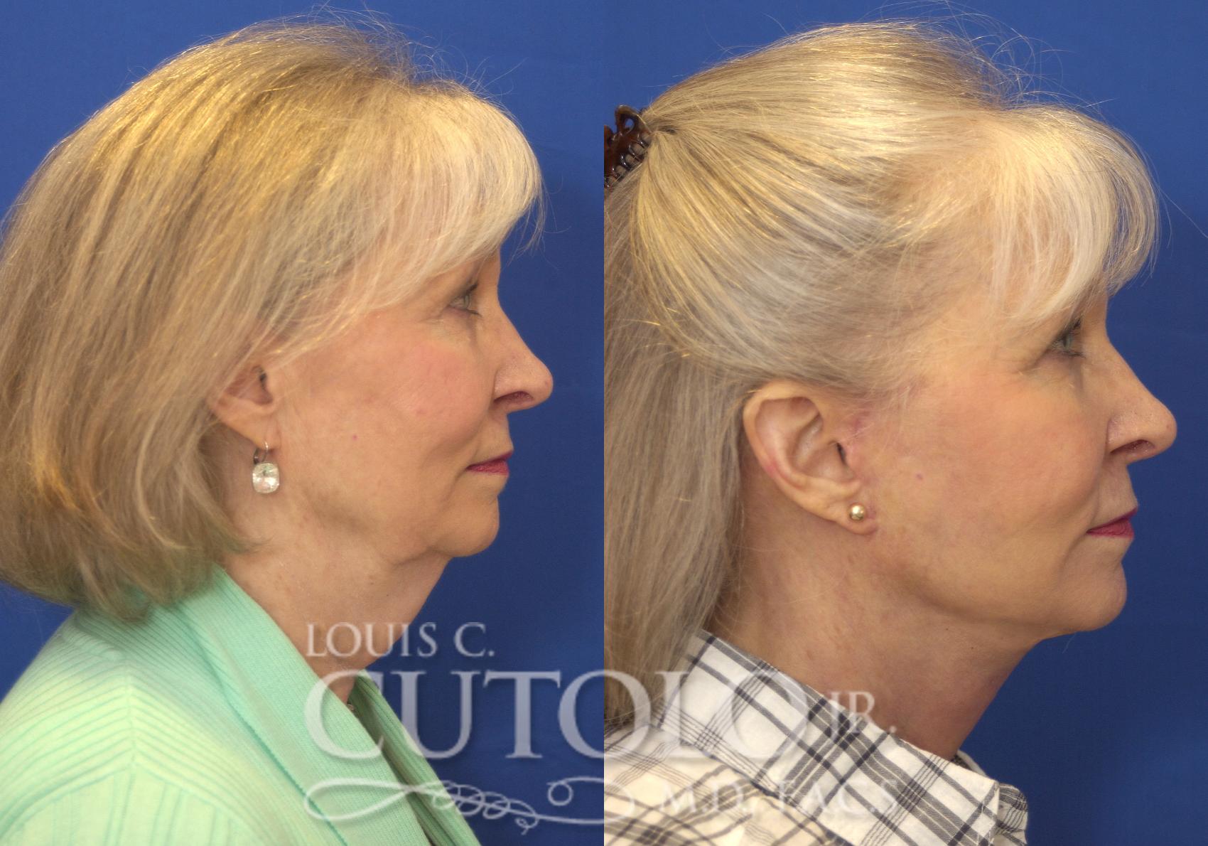 Before & After Rejuvelift™ - Mini Lift Case 149 View #5 View in Brooklyn, Staten Island, Queens, NY