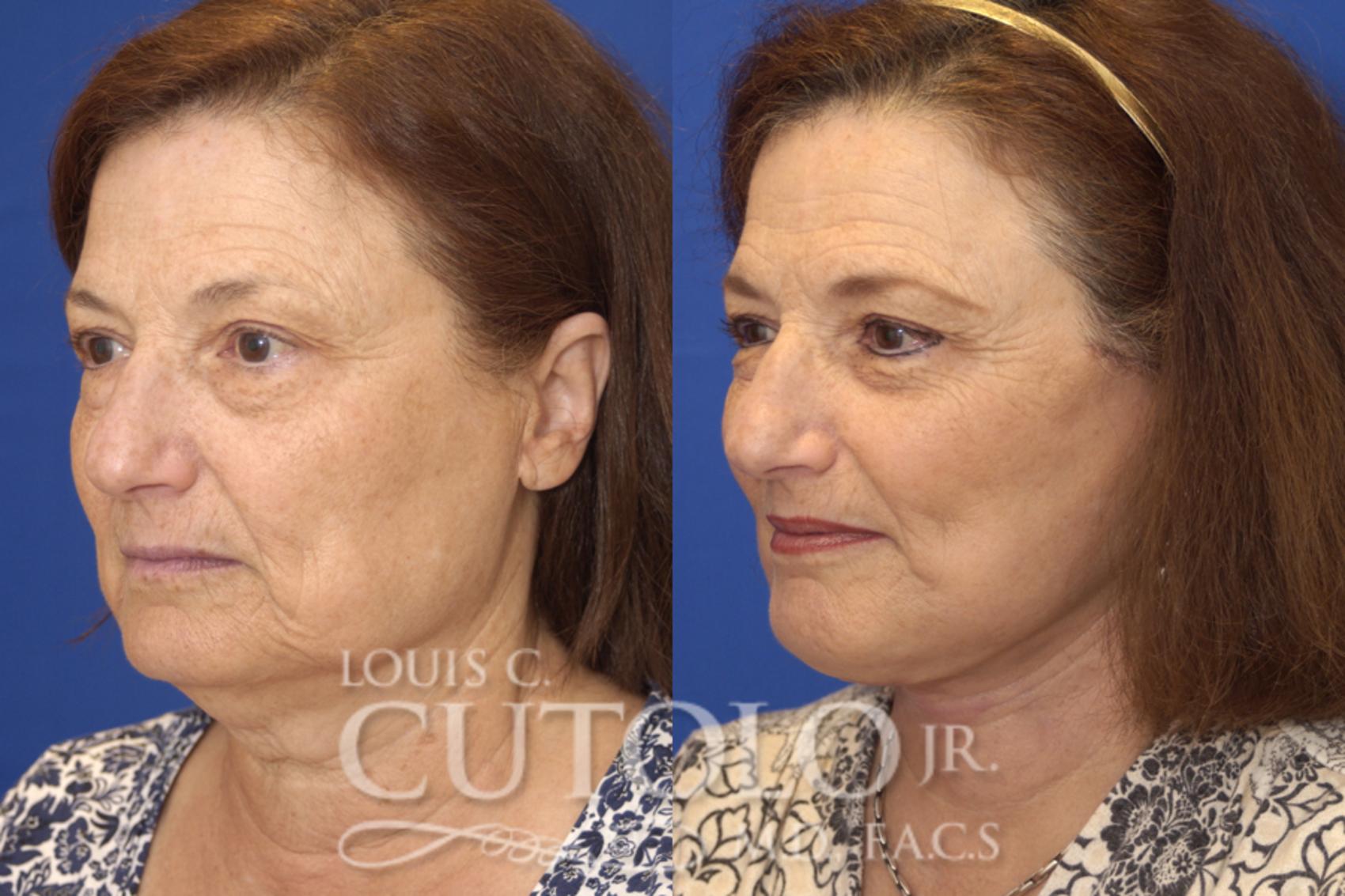 Before & After Rejuvelift™ - Mini Lift Case 15 View #2 View in Brooklyn, Staten Island, Queens, NY