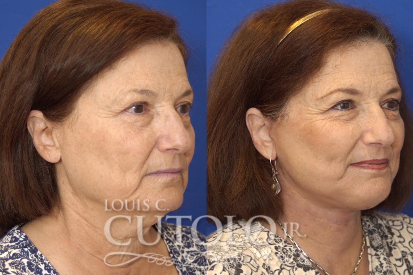 Before & After Rejuvelift™ - Mini Lift Case 15 View #3 View in Brooklyn, Staten Island, Queens, NY