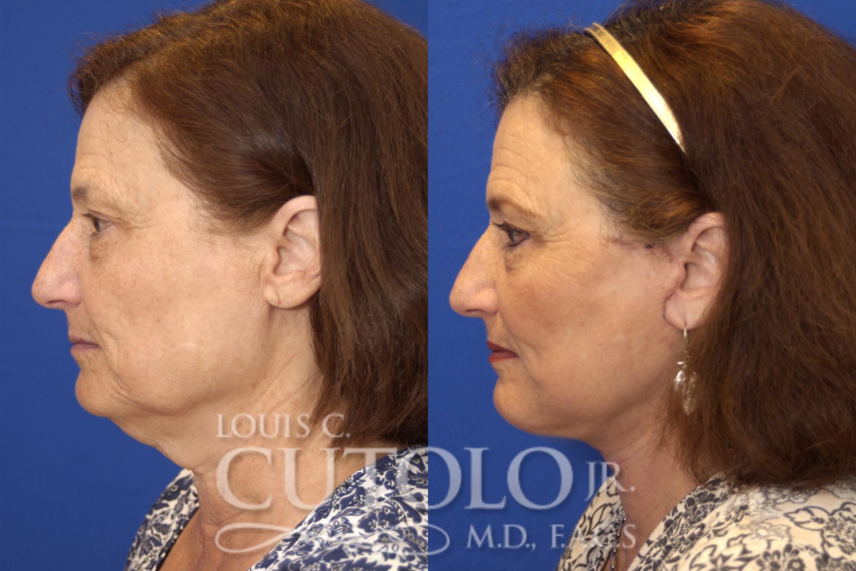 Before & After Rejuvelift™ - Mini Lift Case 15 View #4 View in Brooklyn, Staten Island, Queens, NY