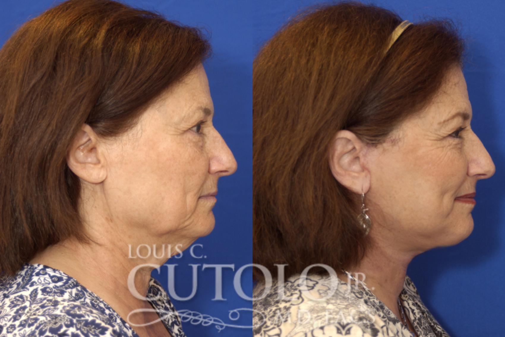 Before & After Rejuvelift™ - Mini Lift Case 15 View #5 View in Brooklyn, Staten Island, Queens, NY