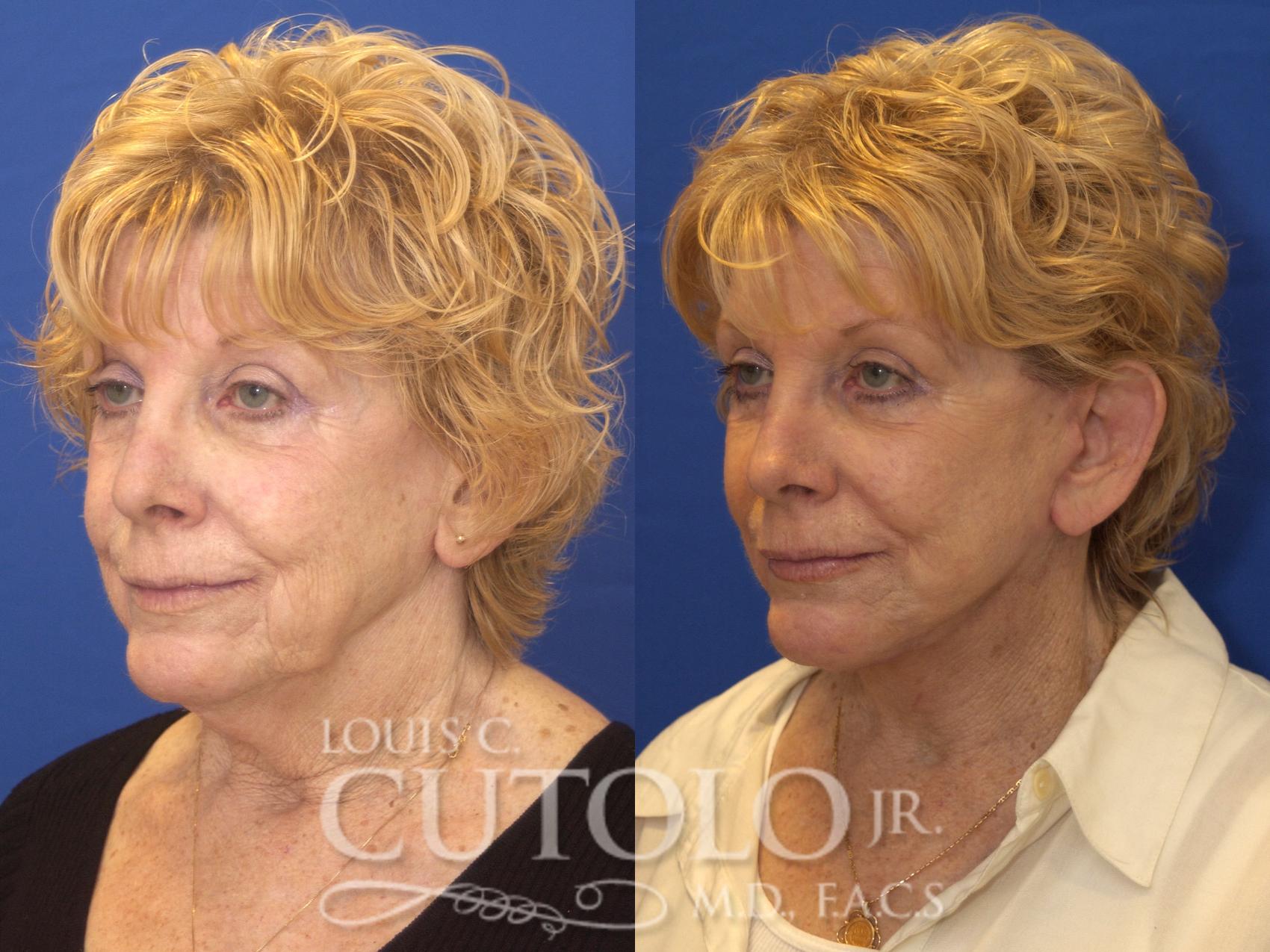 Before & After Rejuvelift™ - Mini Lift Case 163 View #2 View in Brooklyn, Staten Island, Queens, NY