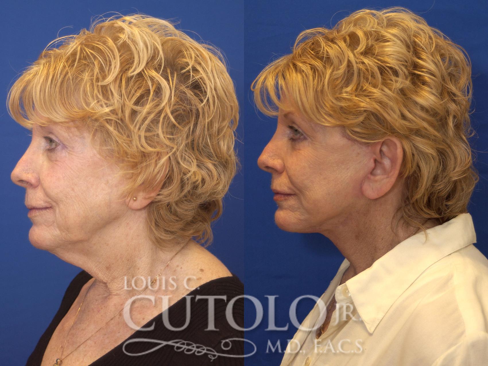 Before & After Rejuvelift™ - Mini Lift Case 163 View #3 View in Brooklyn, Staten Island, Queens, NY