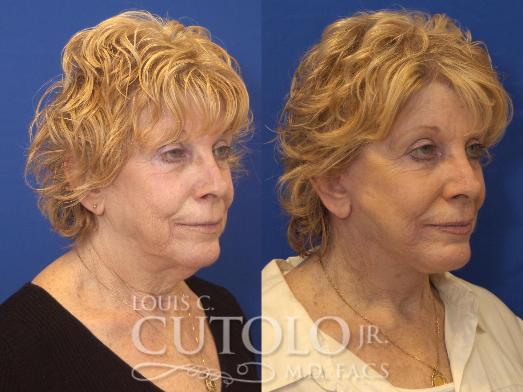 Before & After Rejuvelift™ - Mini Lift Case 163 View #4 View in Brooklyn, Staten Island, Queens, NY