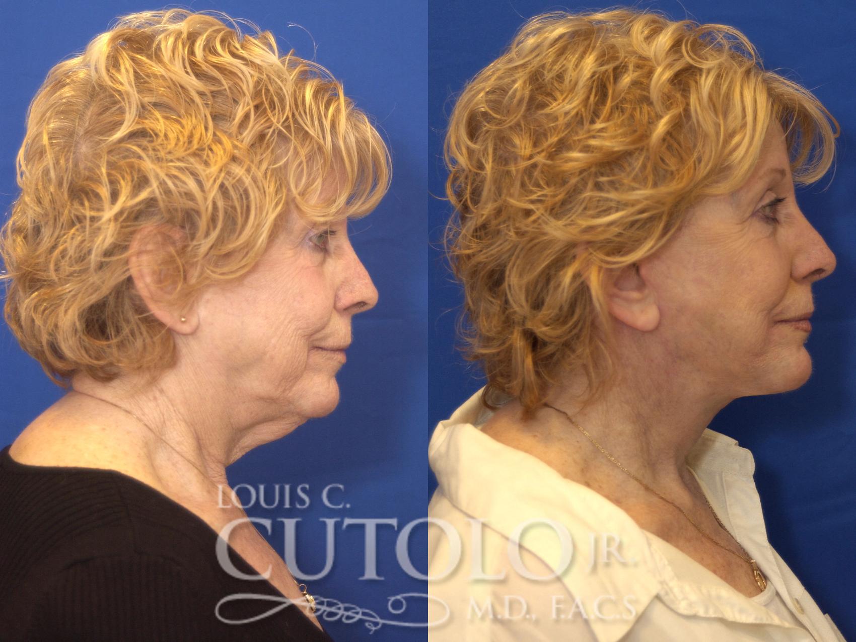 Before & After Rejuvelift™ - Mini Lift Case 163 View #5 View in Brooklyn, Staten Island, Queens, NY