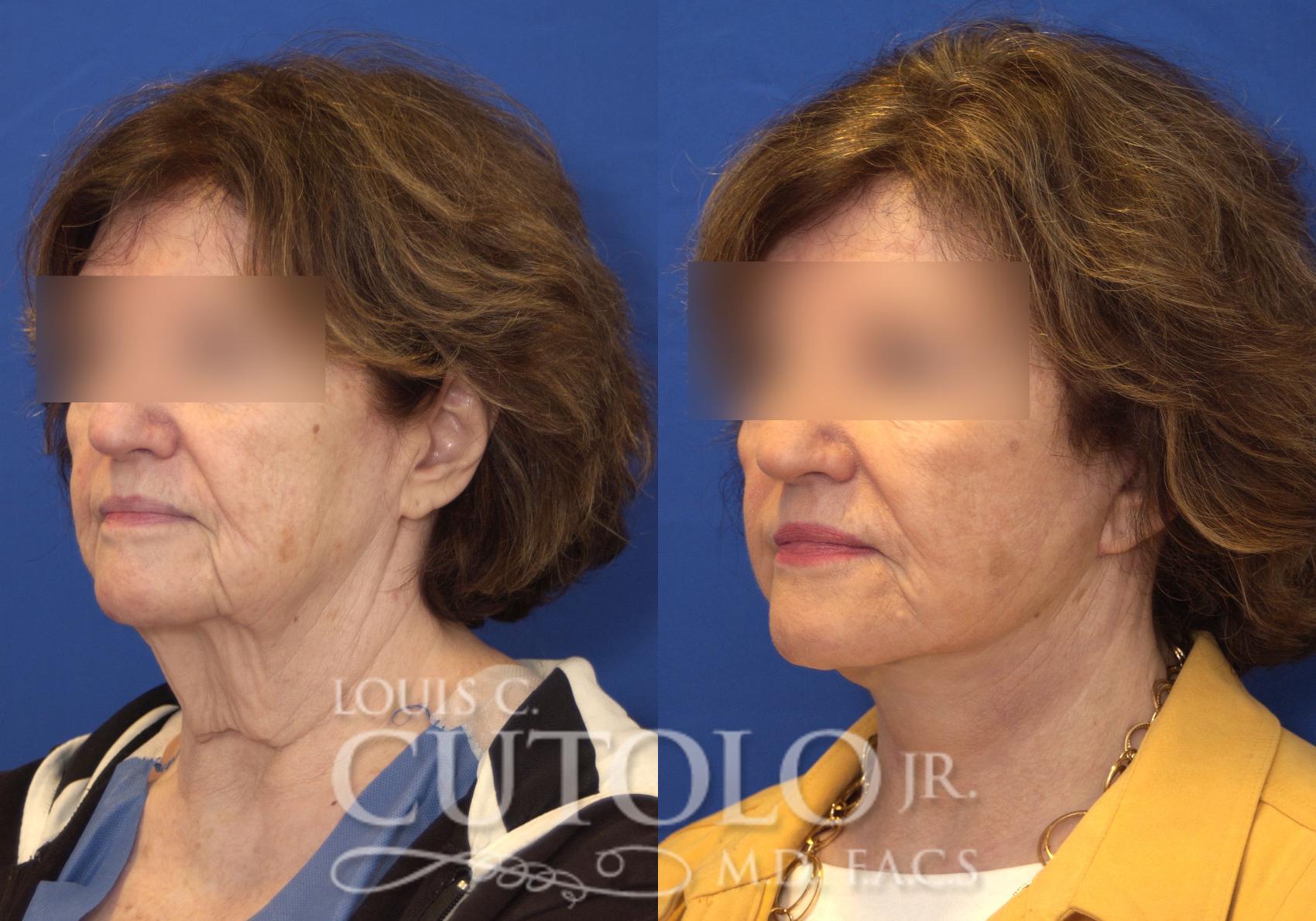 Before & After Rejuvelift™ - Mini Lift Case 166 View #2 View in Brooklyn, Staten Island, Queens, NY