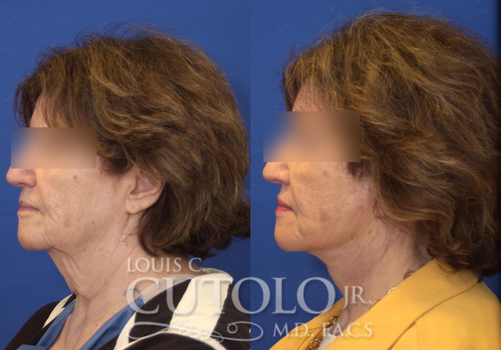Before & After Rejuvelift™ - Mini Lift Case 166 View #3 View in Brooklyn, Staten Island, Queens, NY